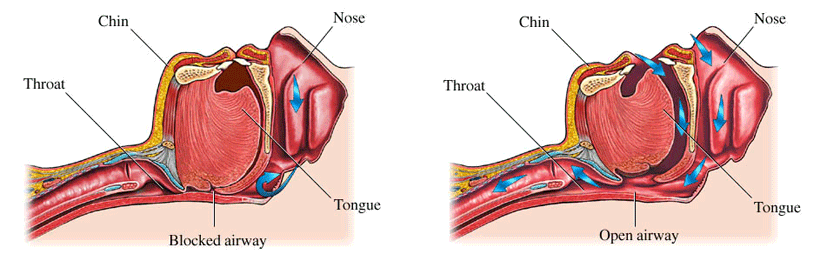 sleep-apnea.2