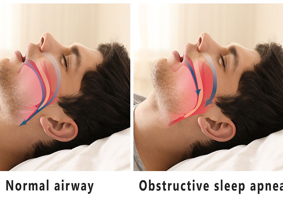 What Are The Signs And Symptoms Of Obstructive Sleep Apnea?