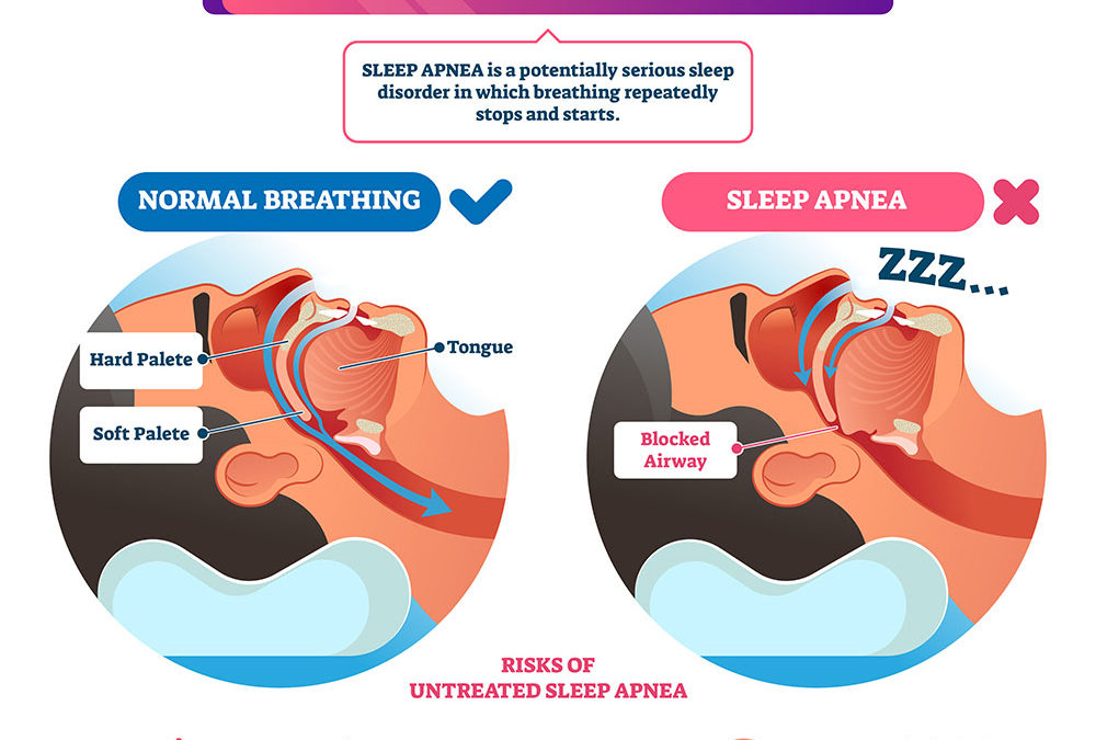 Top Three Myths About Sleep Apnea Debunked